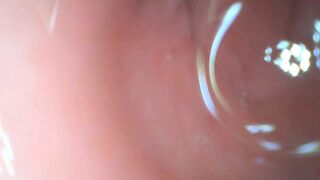 Anal endoscope